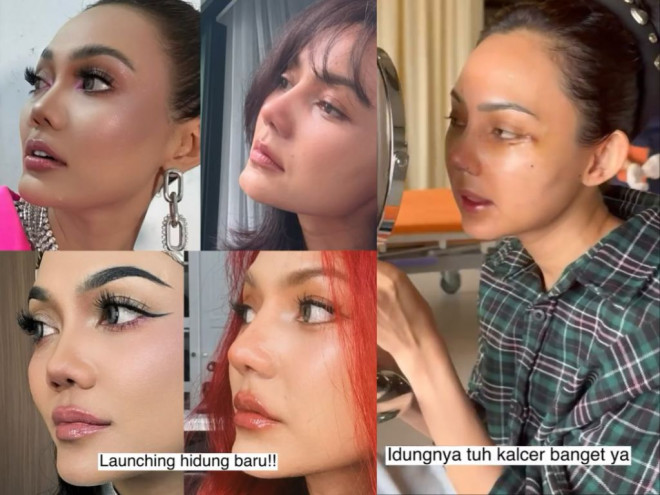 Rina Nose Operasi Hidung (Foto: Instagram/rinanose16)