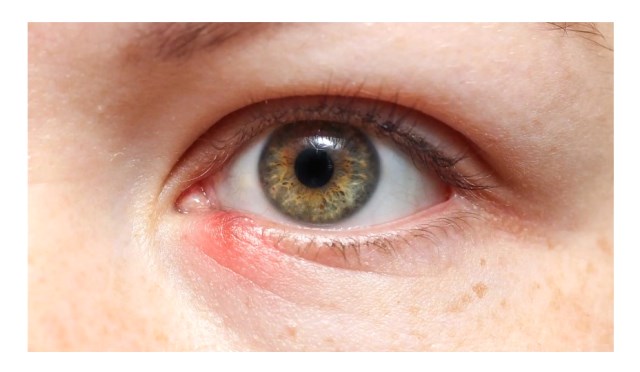 Hordeolum 101: Fakta Bintitan yang Wajib Kamu Tahu Biar Gak Makin Parah