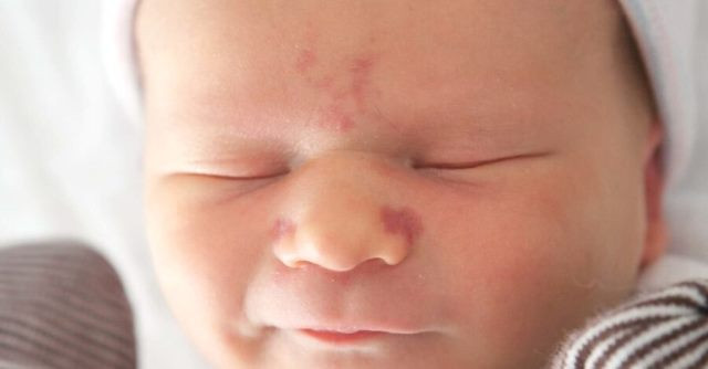 Ternyata Tanda Lahir Bayi Ada Banyak Macamnya Lho! Mana yang Normal?