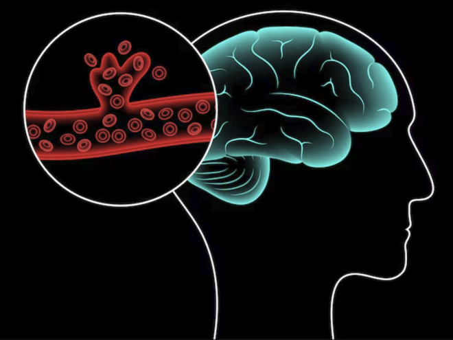 Pasien stroke akibat sumbatan yang mendapatkan penanganan dalam waktu kurang dari 4,5 jam. Ilustrasi Freepik