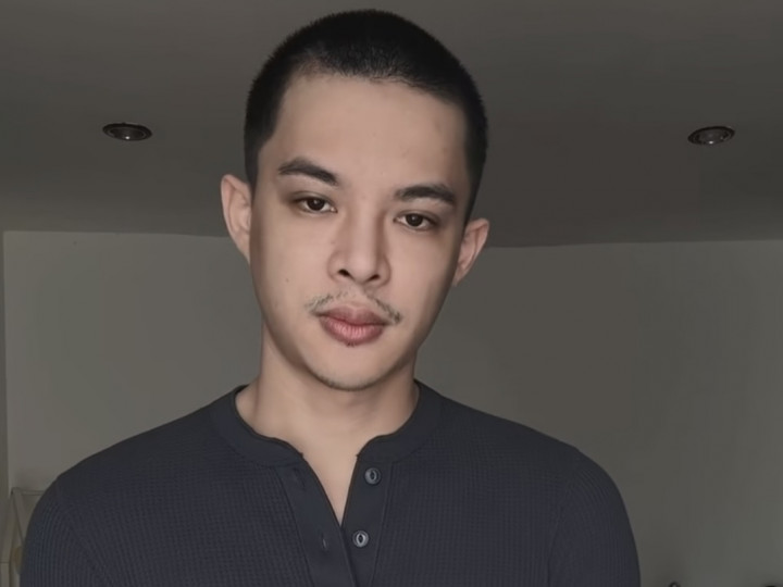 Rey Mbayang Tiba-Tiba Botak, Ternyata Alami Penyakit Ini