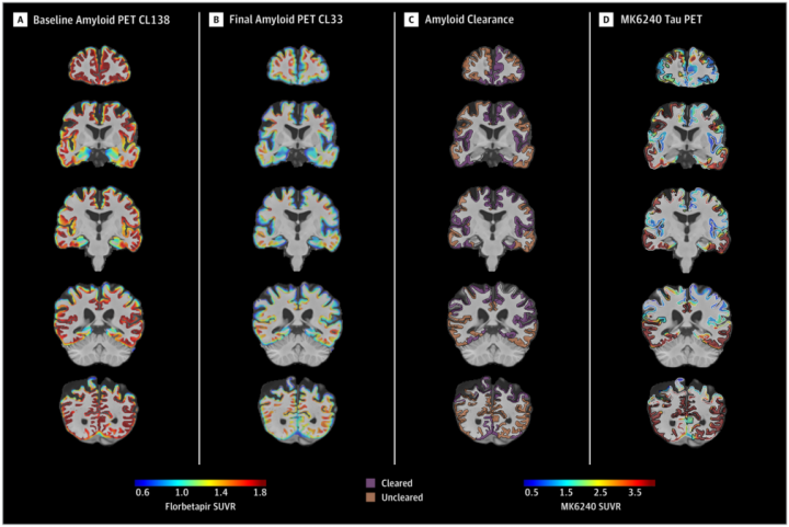 Studi Otopsi Otak Ungkap Alasan Obat Alzheimer Aducanumab Tidak Efektif