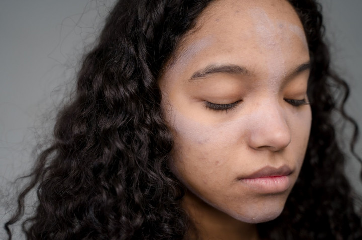 Kandungan Skincare yang Pas Buat Hempas Bekas Jerawat, Jangan Sampai Salah Pilih!