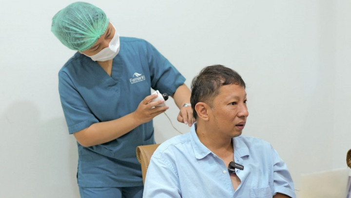 Ringgo Agus Rahman Ungkap Alasan Lanjut Part 2 Transplantasi Rambut