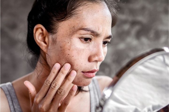 Stop Biarkan Muka Panen Flek! Ini 5 Cara Ampuh Hempas Dark Spot Membandel