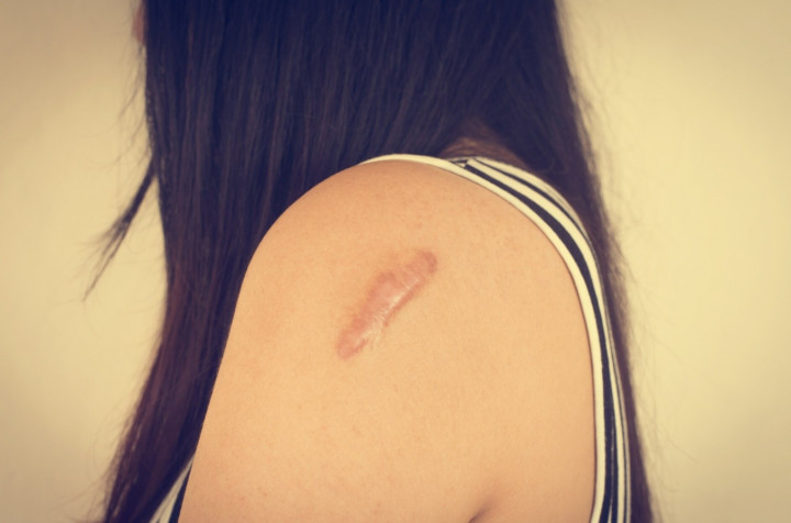 Bukan Sekadar Bekas Luka, Ini Fakta tentang Keloid yang Perlu Kamu Tahu