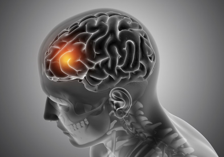 Kenali Code Stroke, Sistem Cepat Tangani Pasien Stroke
