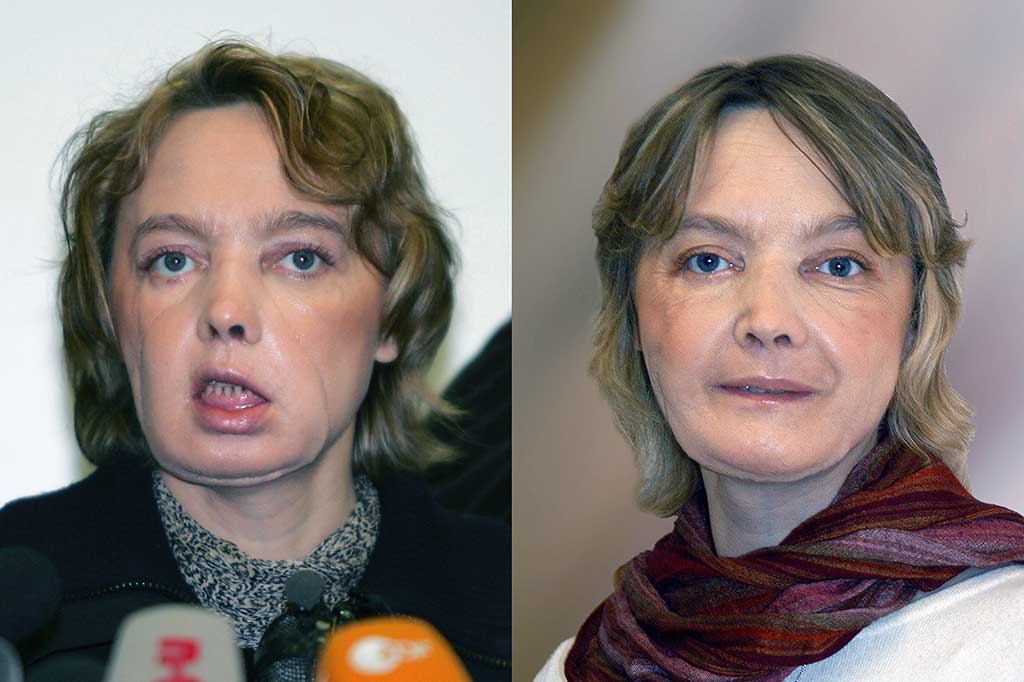 Perempuan asal Prancis Isabelle Dinoire menjalani operasi transplantasi wajah pertama di dunia pada 27 November 2005 saat usianya 38 tahun.