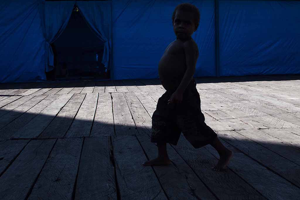 Seorang anak penderita gizi buruk berjalan di teras Aula Gereja Protestan, Agats, Kabupaten Asmat, Papua. 