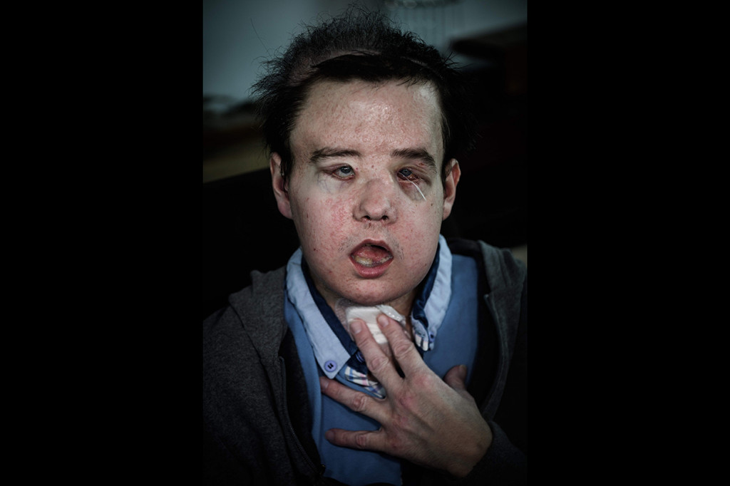 Hamon menderita neurofibromatosis tipe 1, mutasi genetik yang menyebabkan tumor yang sangat merusak dan komplikasi yang terkait.