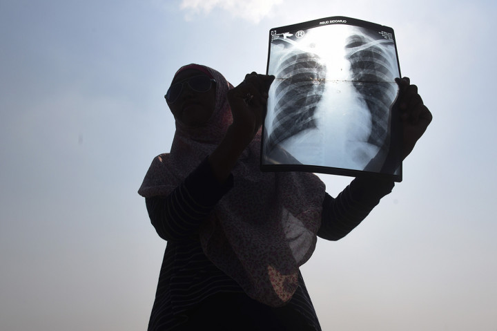 Seorang warga korban lumpur Lapindo menunjukan foto hasil rontgen di titik 25 tanggul penahan lumpur Lapindo saat aksi memperingati 12 tahun semburan lumpur Lapindo di Porong, Sidoarjo, Jawa Timur. 
