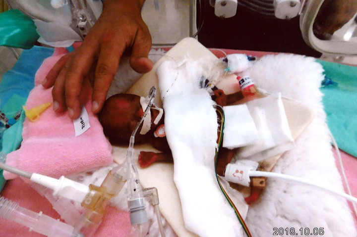 Bayi laki-laki yang tercatat sebagai terkecil di dunia, Ryusuke Sekiya, saat menjalani perawatan di unit perawatan intensif pascakelahiran di Rumah Sakit Nagano, Jepang, pada 5 Oktober 2018 lalu.