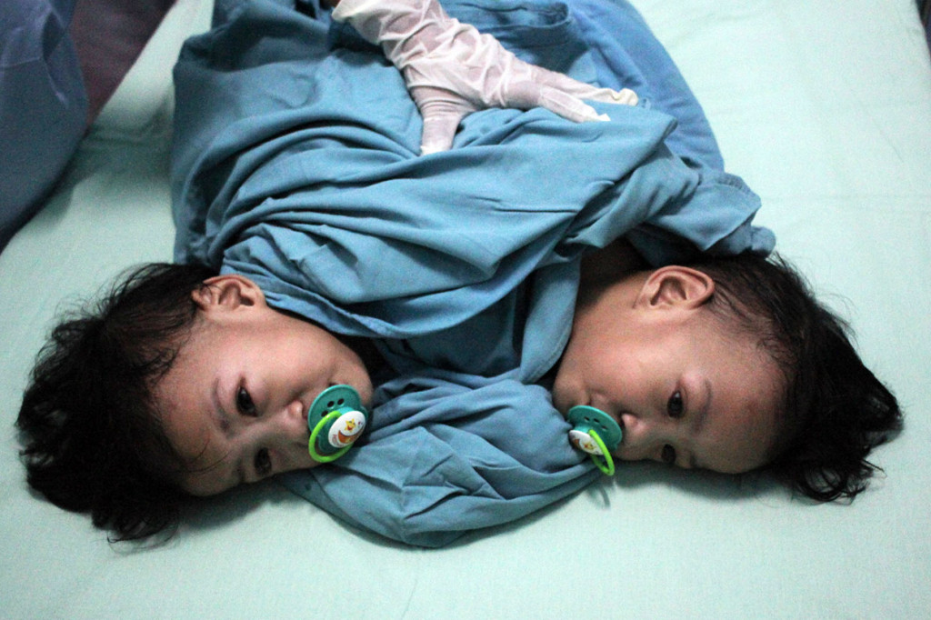 Tim medis menyelimuti Aqila dan Azila kembar siam asal Kendari, Sulawesi Tenggara, sebelum menjalani operasi pemisahan di RSUD Dr Soetomo Surabaya, Jawa Timur, Rabu, 14 Agustus 2019.