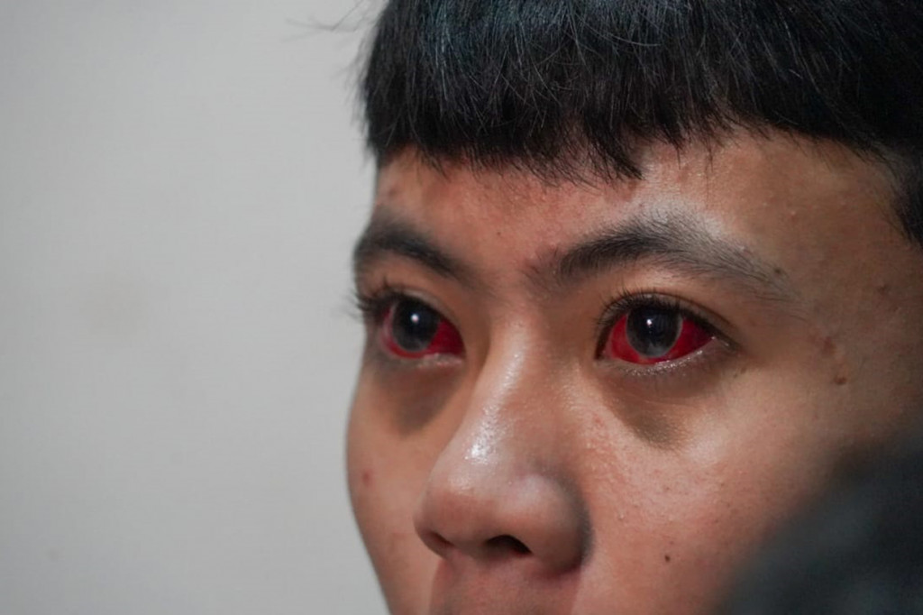 Sang adik mengalami pendarahan dalam mata dan kakaknya sampai detik ini masih batuk dan sesak napas.