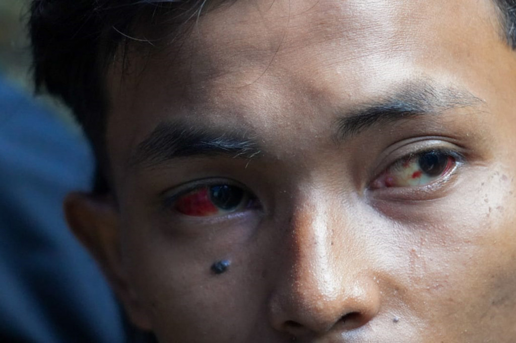 Begitu juga M Iqbal, 16, yang juga mengalami pendarahan dalam mata serta luka-luka di kaki dan pinggang akibat terinjak-injak.
