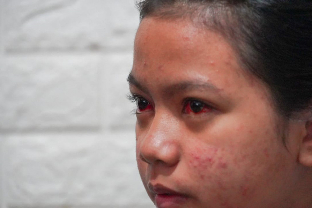 Korban ini mengalami pendarahan dalam mata, sesak napas, dan batuk-batuk. Retina matanya sampai detik ini tidak ada warna putihnya.