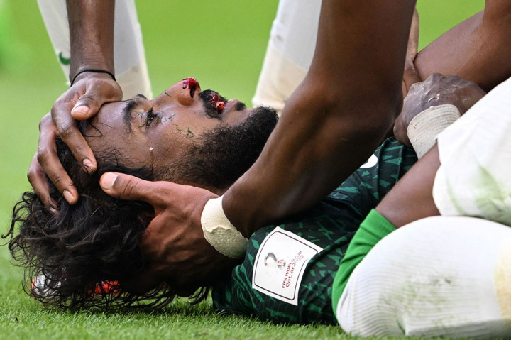 Cedera mengerikan dialami bek Arab Saudi Yasser Al Shahrani setelah benturan brutal di menit-menit terakhir kemenangan timnya atas Argentina di Piala Dunia 2022 Qatar, Selasa, 22 November 2022.