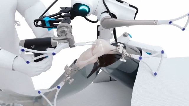VELYS Robotic membantu dokter menyediakan data secara real time yang berguna akan kondisi anatomi pasien saat operasi sehingga dapat mengambil kesimpulan dengan cepat. (Foto: Dok. Mark Hood MD)
