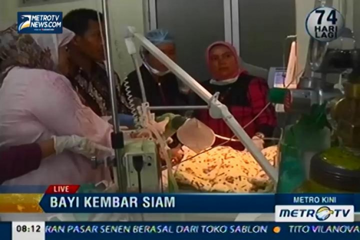 Akhirnya Bayi Kembar Siam Meninggal Dunia