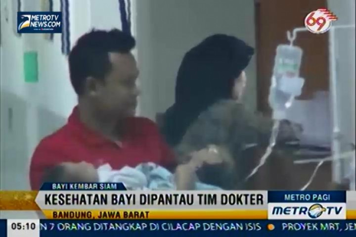 RS Hasan Sadikin Bandung Rawat Bayi Kembar Siam Dempet Pinggul