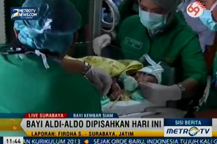 Bayi Kembar Siam Aldi dan Aldo Jalani Operasi Pemisahan