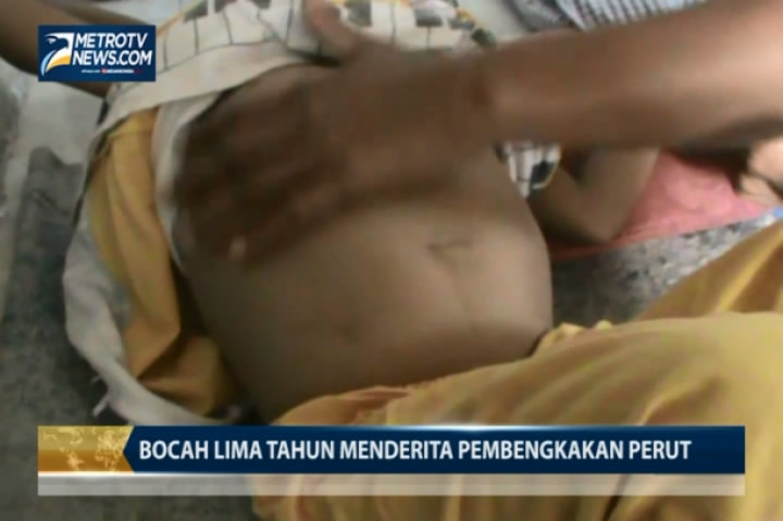 Bocah Lima Tahun Menderita Pembengkakan Perut 