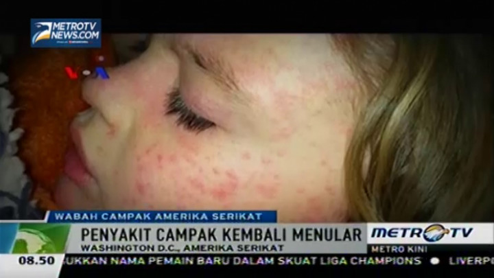 Wabah Campak Kembali Merebak di Amerika Serikat