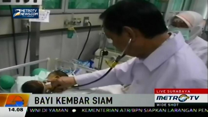 Kondisi Bayi Kembar Dempet Perut dan Dada Kini Membaik