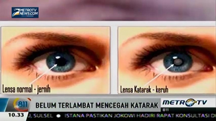 Ini Faktor Penyebab Mata Terkena Katarak