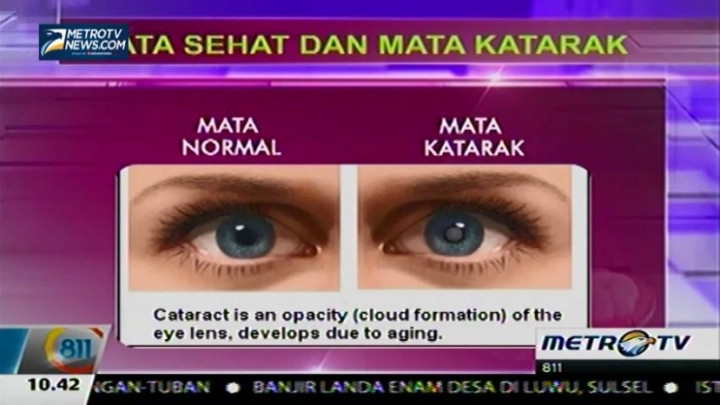 Cara Membedakan Mata Sehat dan Mata Katarak