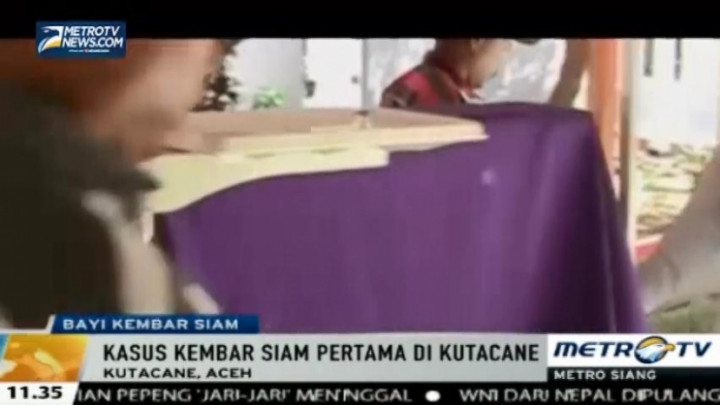 Bayi Kembar Siam Dempet Kepala Lahir di Aceh Tenggara