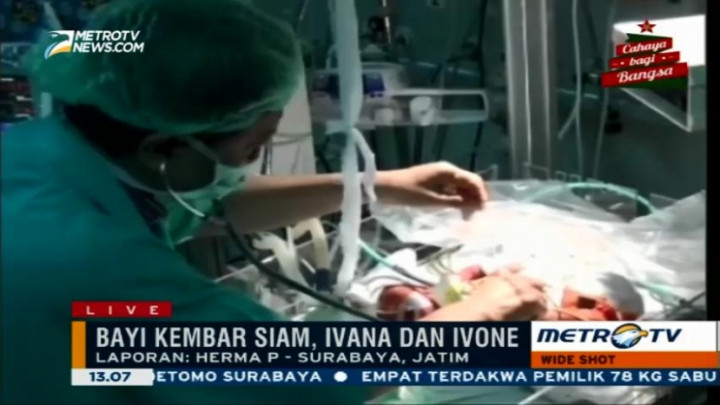 50 Tenaga Medis Tangani Operasi Pemisahan Bayi Kembar Siam Ivon-Ivana 