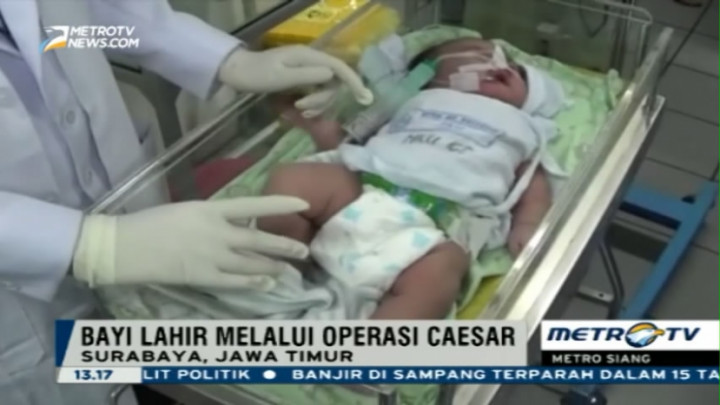 Bayi Jumbo Lahir di RSUD Dr Soetomo Surabaya