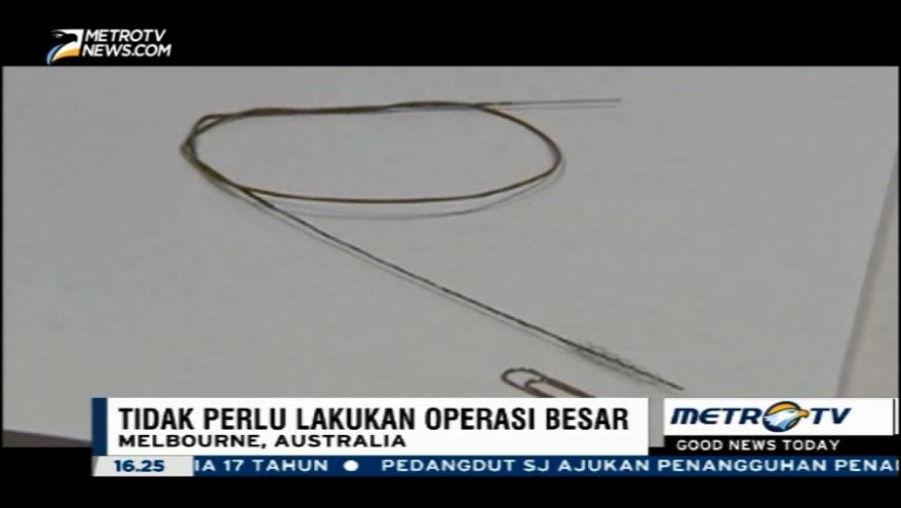 Peneliti Kembangkan 'Stentrode' untuk Bantu Pasien Lumpuh 