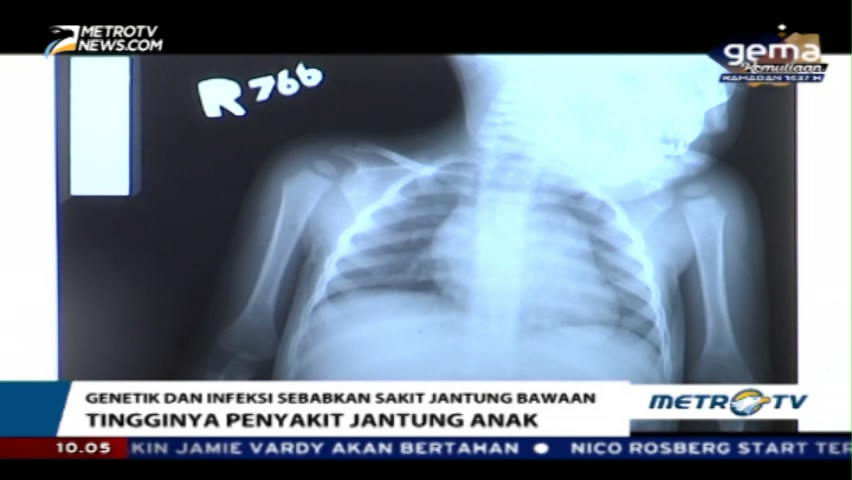 Penyebab Tingginya Gangguan Jantung pada Anak
