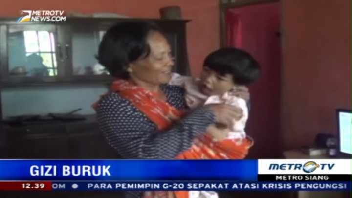 Bocah di Cianjur Penderita Gizi Buruk Butuh Bantuan