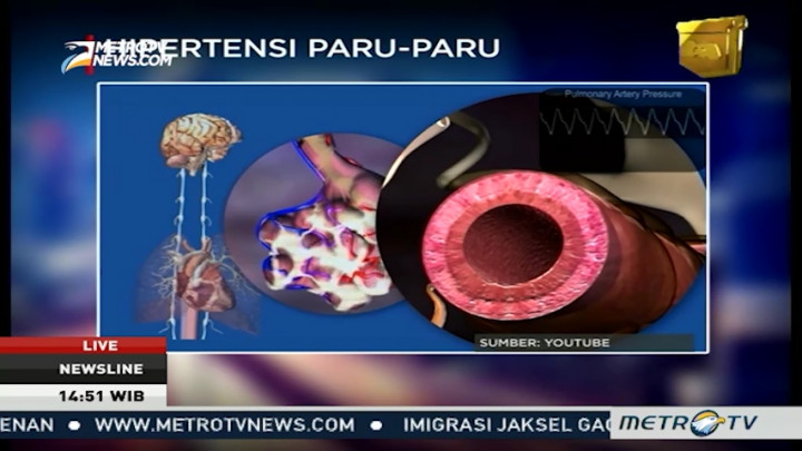 Berjuang Melawan Hipertensi Paru-paru (2)