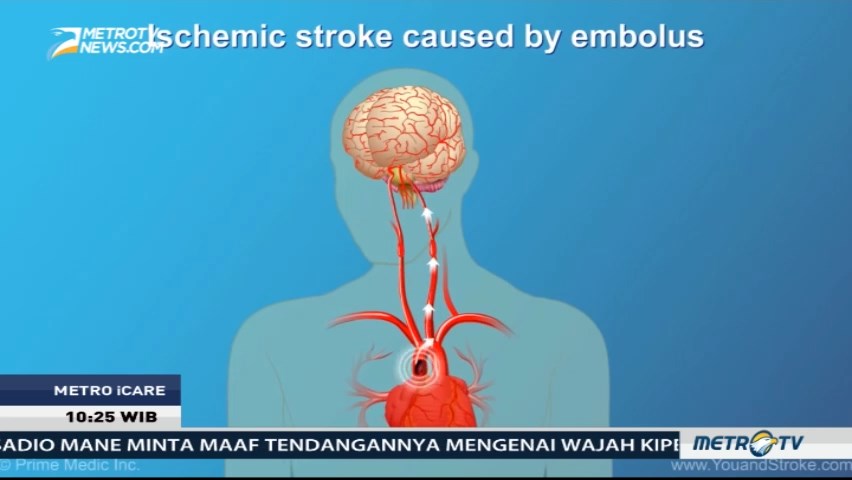 Ini Faktor-faktor Risiko Stroke