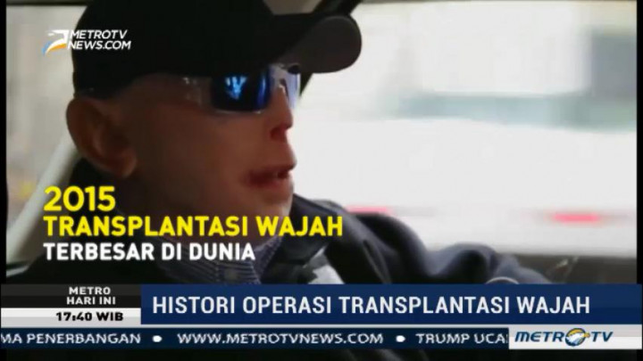 Sejarah Operasi Transplantasi Wajah