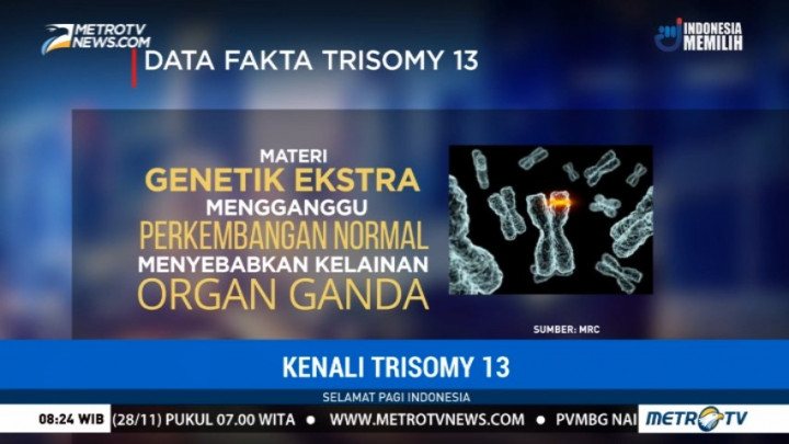 Kenali Penyakit Langka Trisomy 13