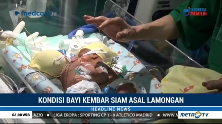 Bayi Kembar Siam di Surabaya Dirawat di RSUD dr Soetomo