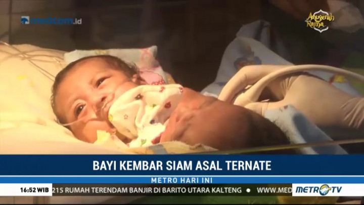 Bayi Kembar Siam asal Ternate Dirujuk ke RSUD dr Soetomo