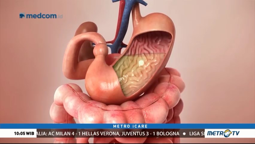 Waspada Penyakit Lambung