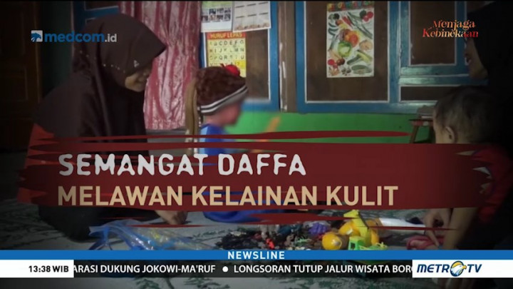 Semangat Daffa Lawan Penyakit Kulit Langka