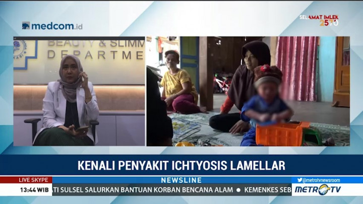 Kenali Penyakit Ichthyosis Lamellar