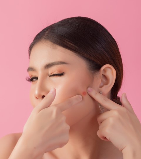 Cara Mengatasi Jerawat