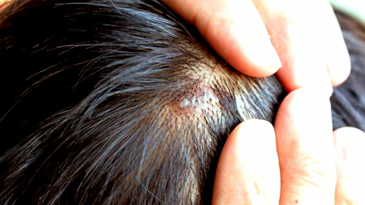 Cara Atasi Jerawat yang Timbul di Kulit Kepala