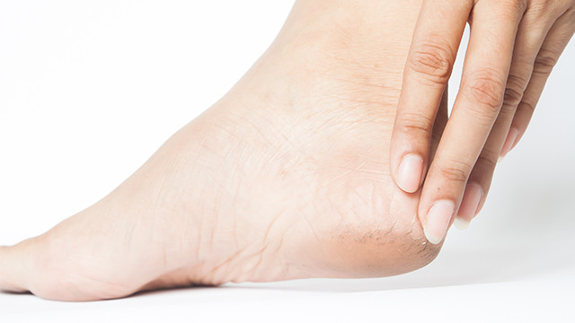 Tumit Pecah-pecah? Obati dengan 5 Bahan Ini