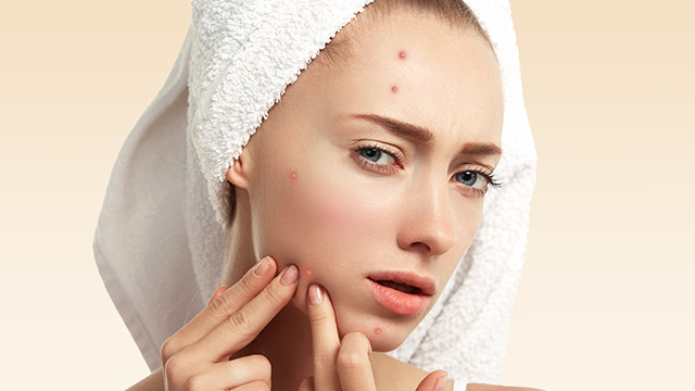 Redakan Jerawat dalam Semalam dengan Cara Ini