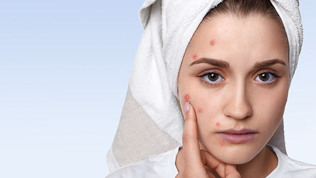 Gunakan 5 Bahan Alami Ini untuk Atasi Masalah Jerawat